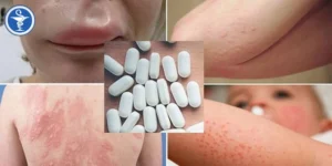 dị ứng thuốc kháng sinh