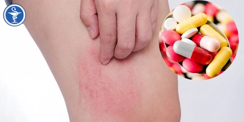 dị ứng thuốc kháng sinh Những biểu hiện ngoài da dễ nhận thấy