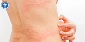 Hình ảnh dị ứng thuốc kháng sinh