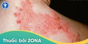 Thuốc bôi zona